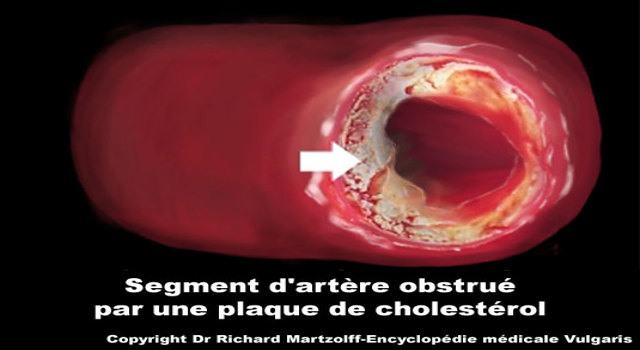 La vérité sur les médicaments anti-cholestérol